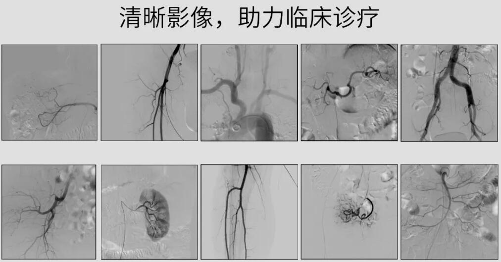 介入c臂機高清影像