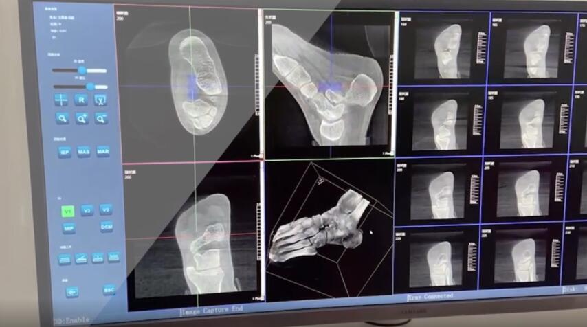【醫療科普】：踝關節三維掃描