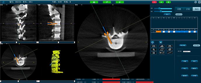 脊柱手術(shù)機(jī)器人準(zhǔn)確定位